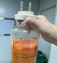 桐城水动力吸脂手术要做多久？